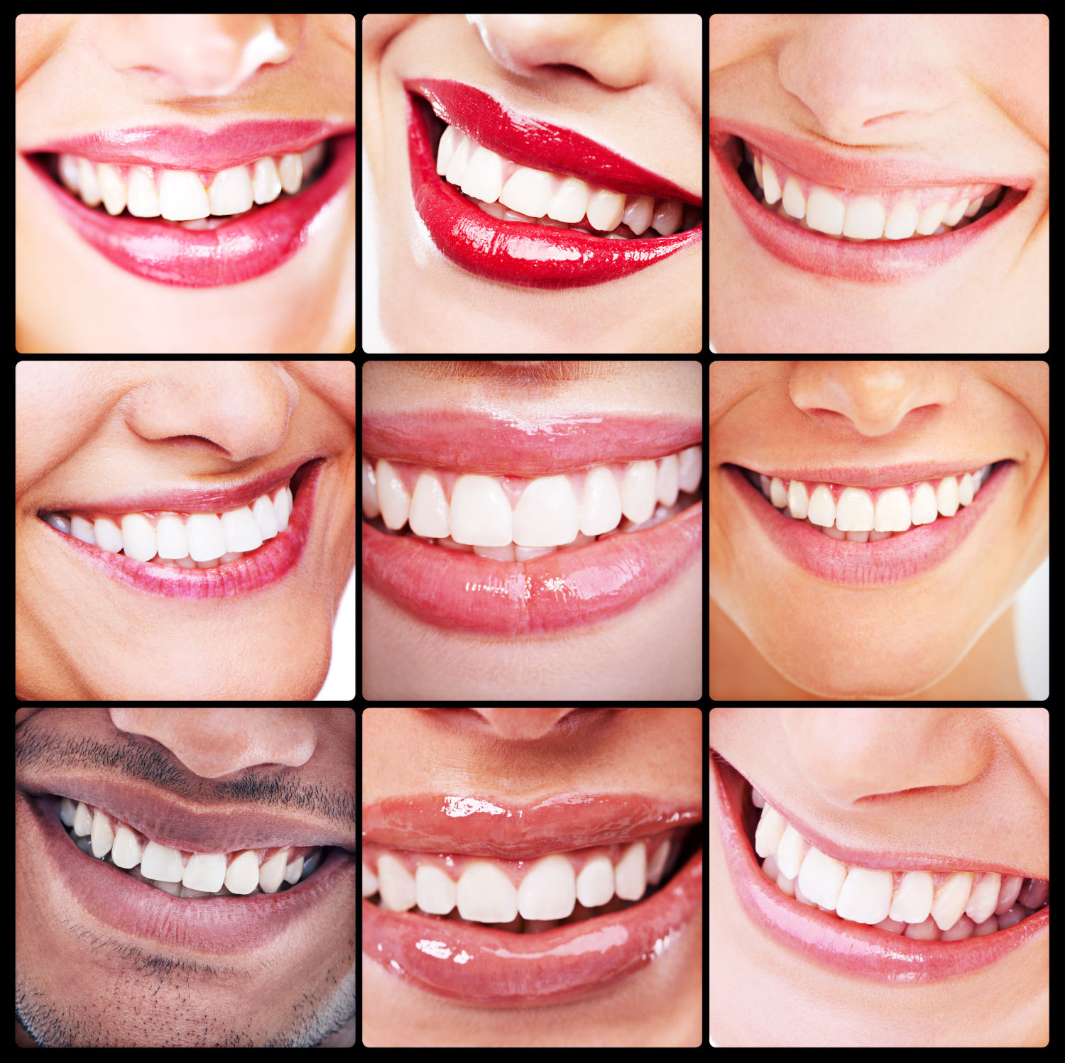 iSmile Teeth Whitening Kit: Your At-Home Secret to a Dazzling Smile